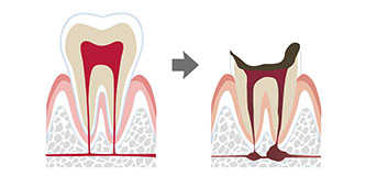 根管治療とは
